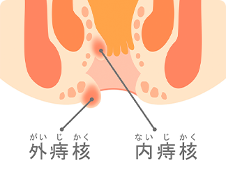 痔核（いぼ痔）