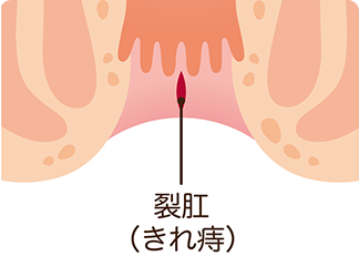 裂肛（切れ痔）