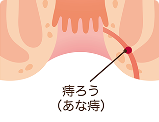 肛門周囲膿瘍、痔瘻（じろう）