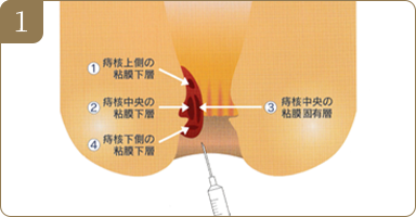 01ジオン注射は四段階注射法といって図のようにひとつの痔核に4か所に分けて注射し、薬液を十分に浸透させます。複数の痔核がある場合は同様に行います。注射後は落ち着くまで30分～1時間程度の安静が必要です。
