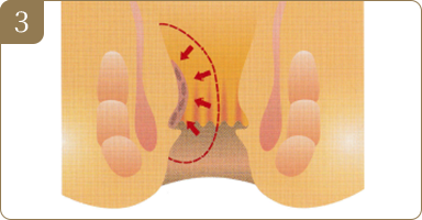 03腫大していた痔核は次第に小さくなり、引き伸ばされていた支持組織を元の位置に癒着・固定させ、脱出を改善します。(1週間～1か月)