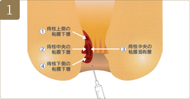 01ジオン注射は四段階注射法といって図のようにひとつの痔核に4か所に分けて注射し、薬液を十分に浸透させます。複数の痔核がある場合は同様に行います。注射後は落ち着くまで30分～1時間程度の安静が必要です。