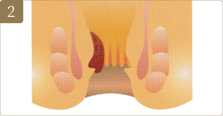 02投与後の早い時期に痔核ヘ流れ込む血夜の量を湖らし、翌日には出血を止めて、脱出の程度も軽くします