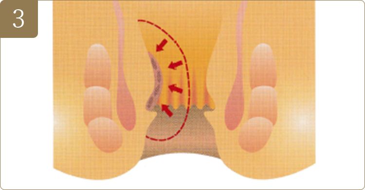 03腫大していた痔核は次第に小さくなり、引き伸ばされていた支持組織を元の位置に癒着・固定させ、脱出を改善します。(1週間～1か月)