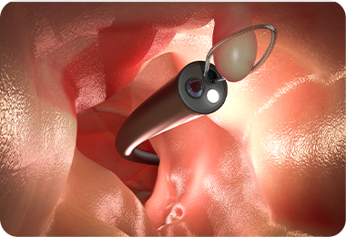 大腸ポリープは切除した方が良い？