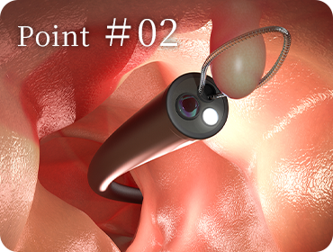 point02 大腸がんのリスクがある大腸ポリープは日帰りで切除可能