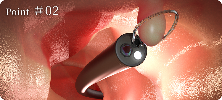 point02 大腸がんのリスクがある大腸ポリープは日帰りで切除可能